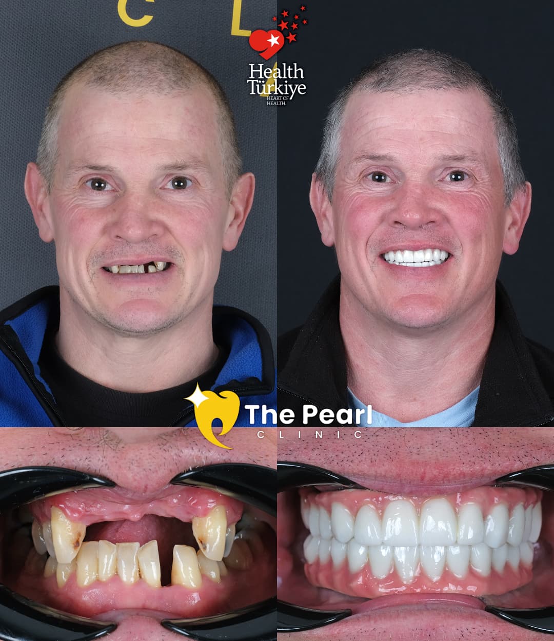 All-on-6 Transformation 2